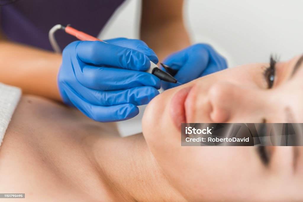Gloved hand holding an electrolysis device to the upper lip during a face treatment, client relaxed on a table